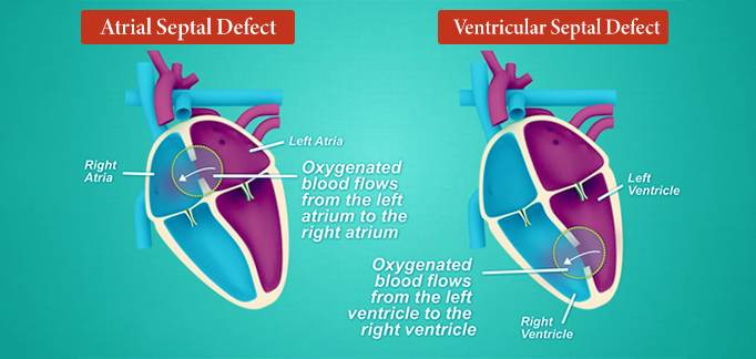 ASD | VSD | PDA |RSOV Device Closure