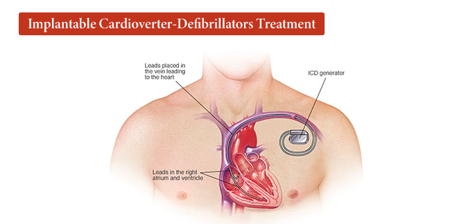 Implantable Cardioverter Defibrillator