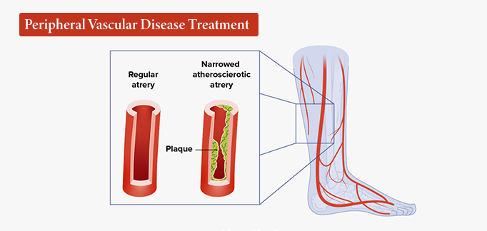 Peripheral Vascular Disease