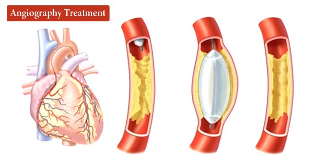 Angiography Treatment