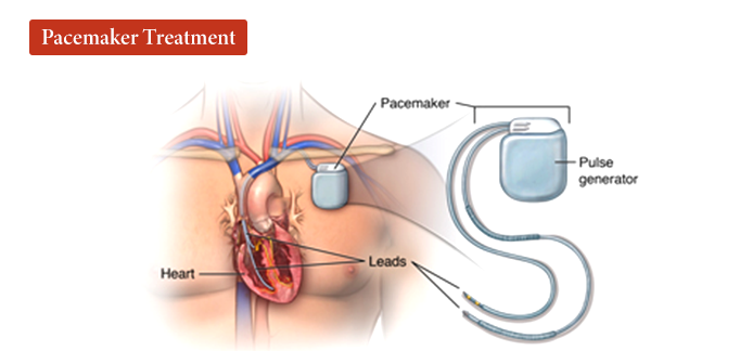 Pacemaker device